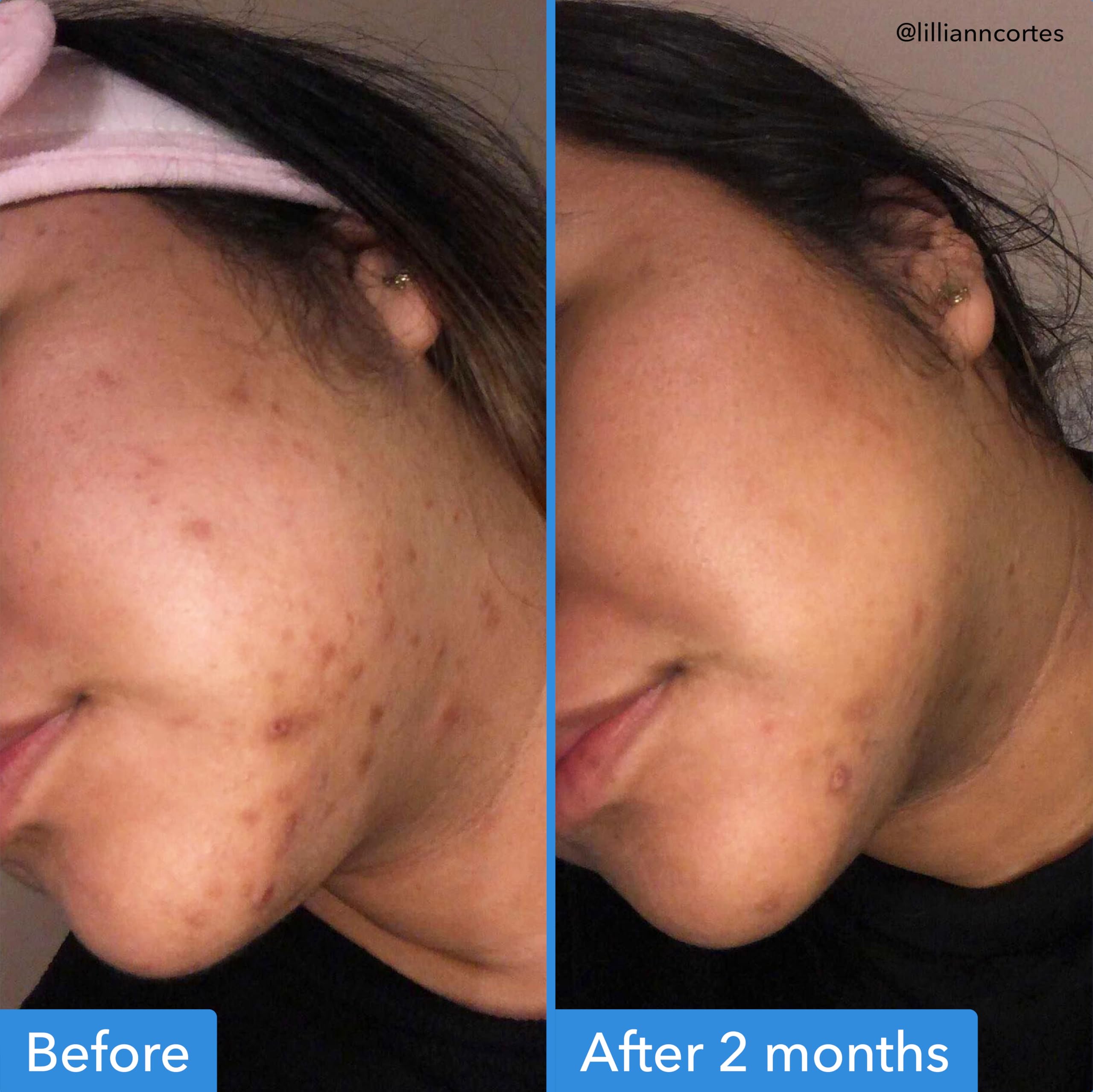 Good Molecules DCCS Pack 3 ingredients graphic highlights tranexamic acid and niacinamide.