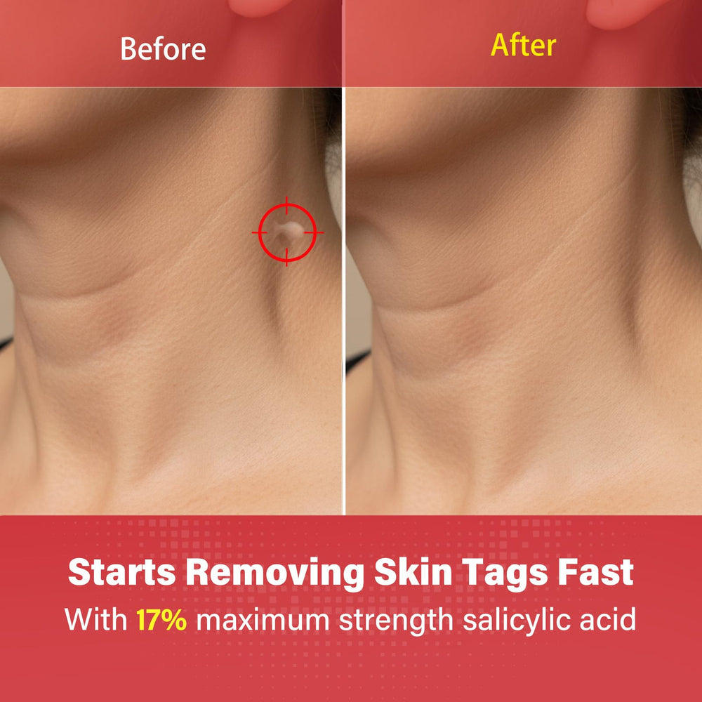 Goodnites Skin Tag Remover dot on skin demonstrating targeted treatment.