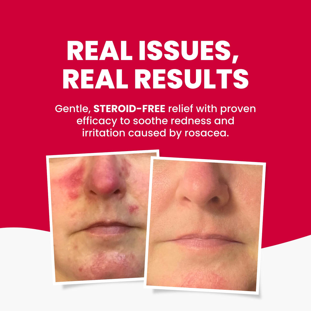 Grahams Natural Rosacea Cream label highlighting natural ingredients