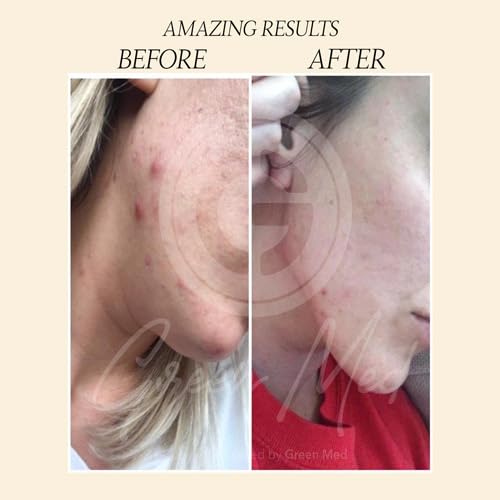 Green Med African Black Soap lather showcasing deep cleansing action.