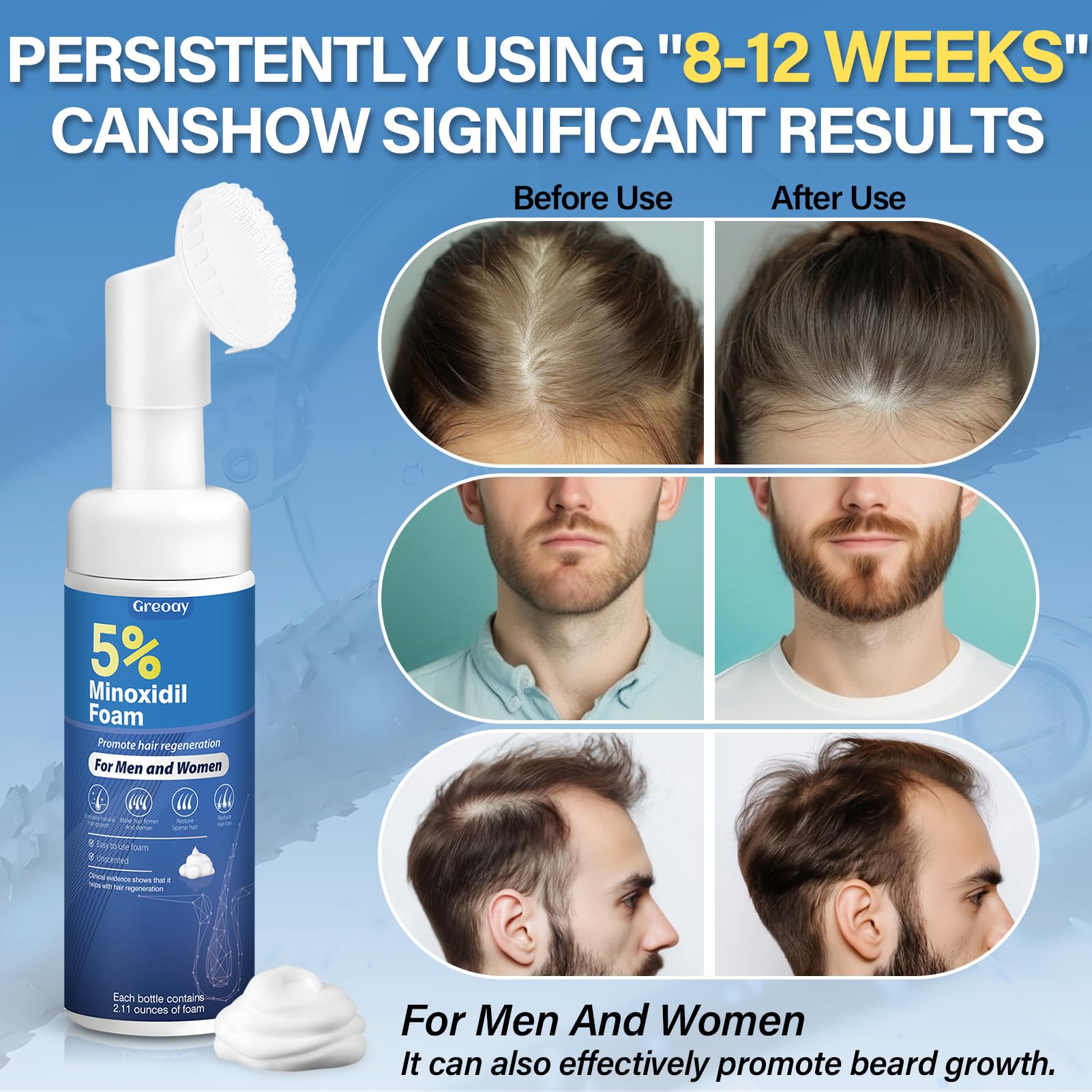 Greoay Minoxidil Mousse : application cuir chevelu pour soutenir la vitalité capillaire.
