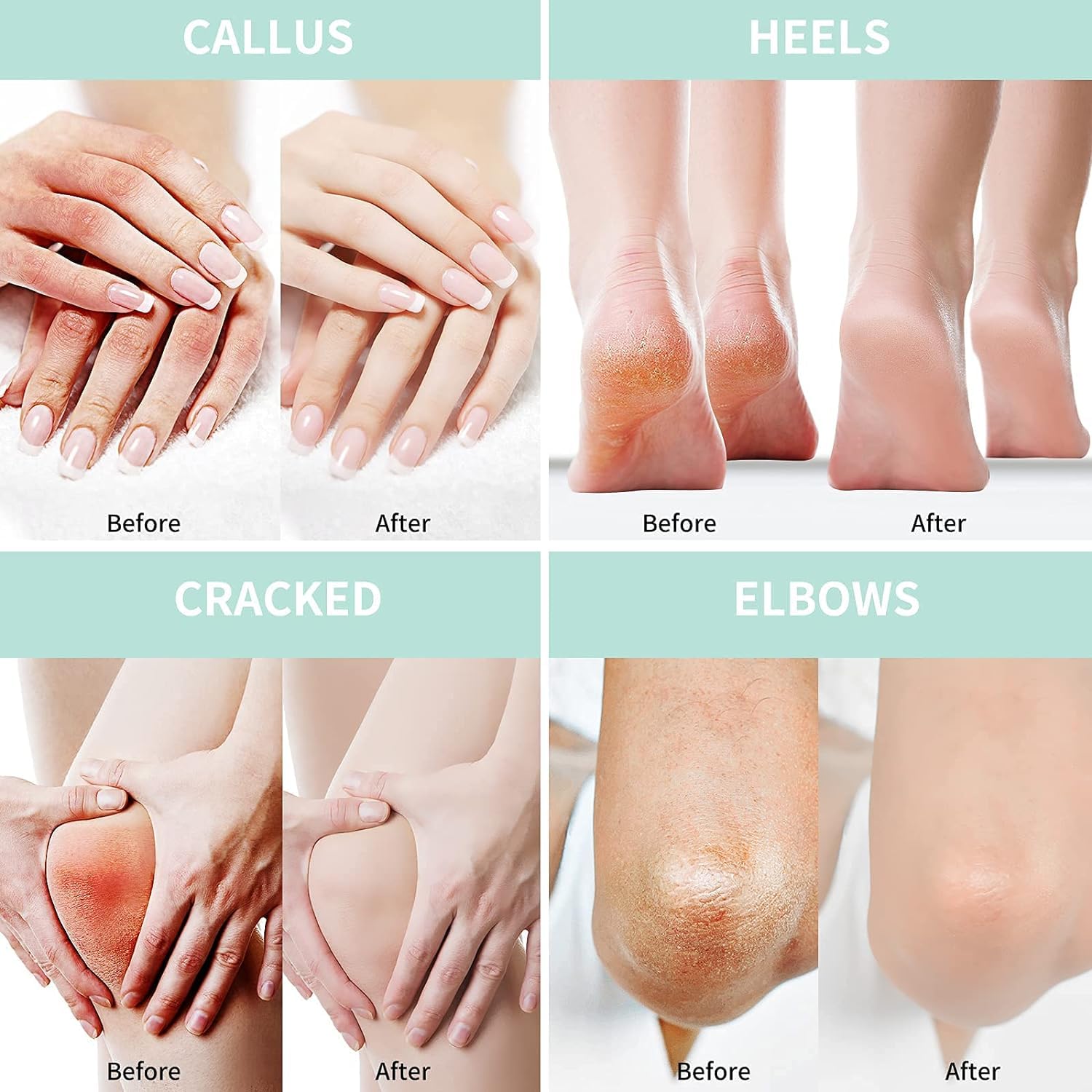 Grocerism Urea Cream on feet and hands emphasizes targeted care for rough areas.