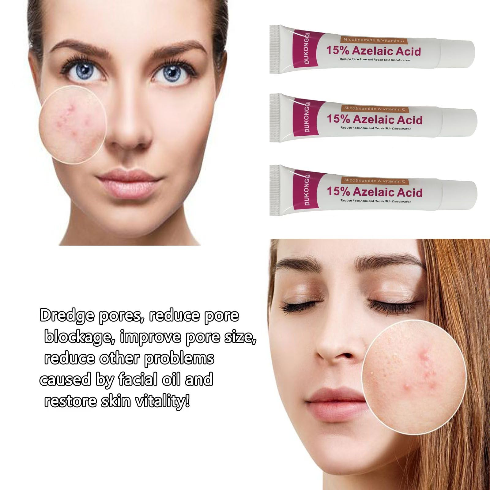 Gzchaox azelaic acid cream 15 pore care visible improvement in texture.