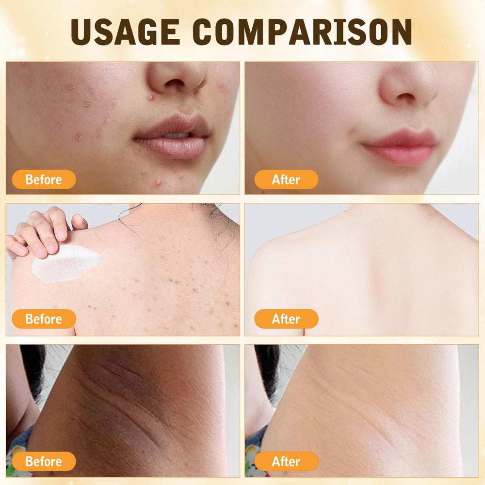 Hadaclub Bee Venom Cream front packaging view emphasizing all-skin compatibility