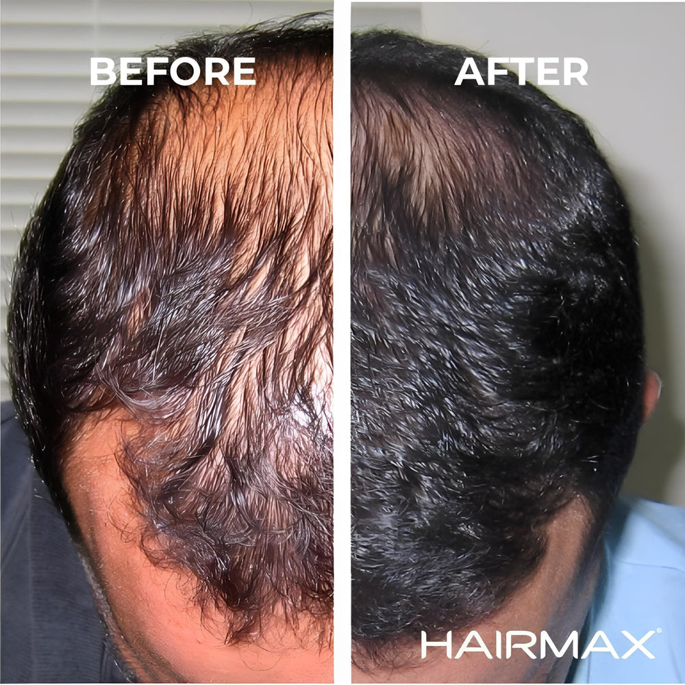 HairMax Ultima 12 LaserComb control panel with a simple interface.