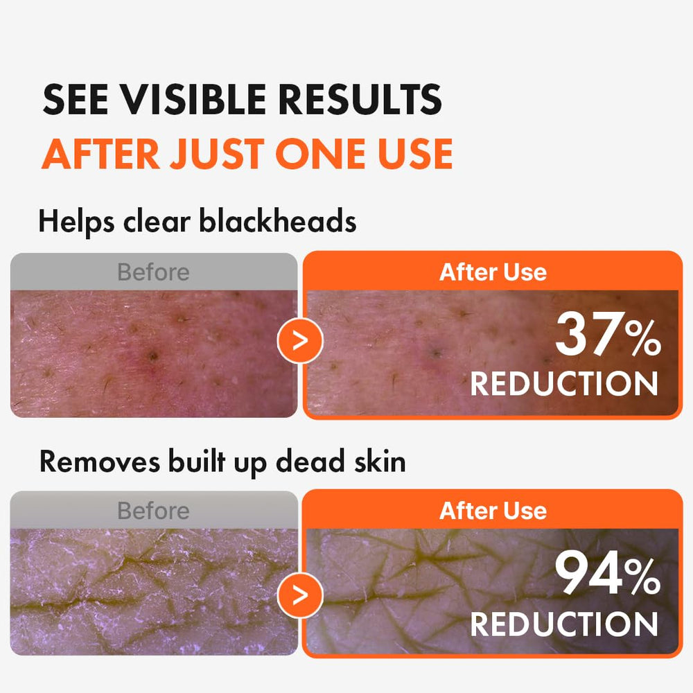 Deep pore cleansing with Hanskin AHA Pore Cleansing Oil and plant oils.