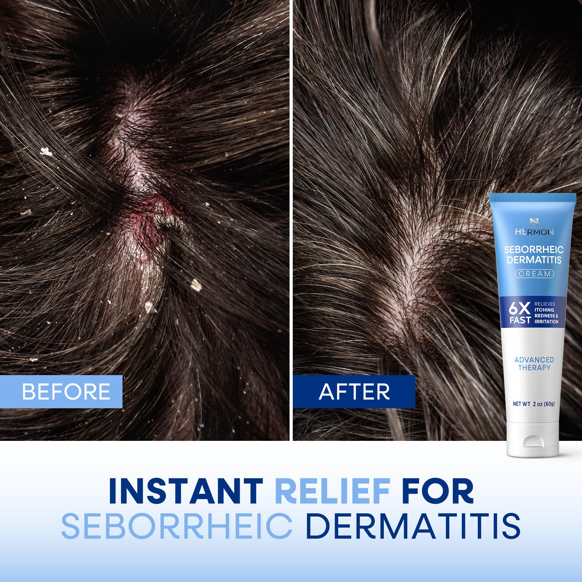Hermon face skin ointment jar ready for facial and neck use.