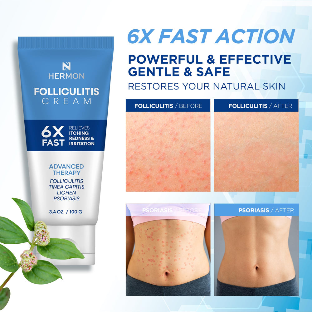 Close-up of Hermon Folliculitis Cream label with gentle formula.