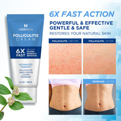 Close-up of Hermon Folliculitis Cream label with gentle formula.