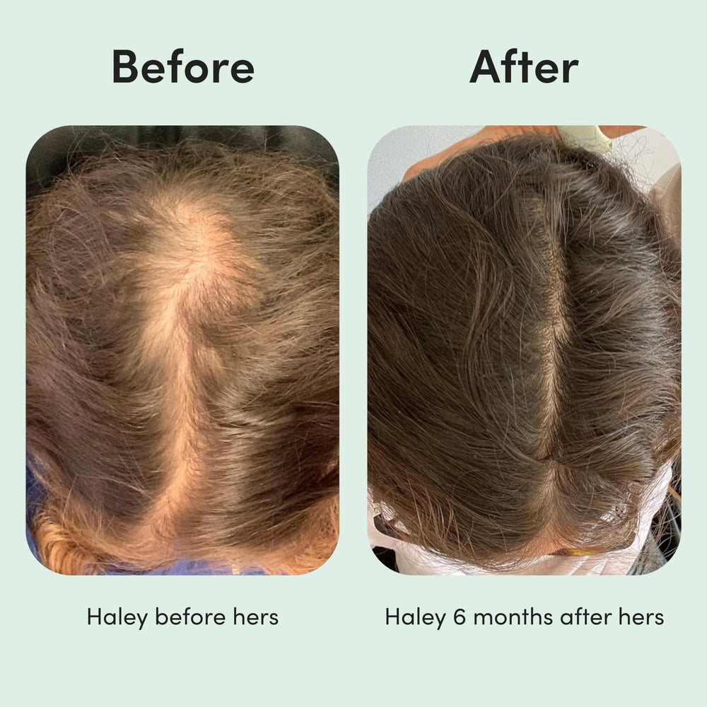 hers 2-percent minoxidil treatment supports hair care without fragrance