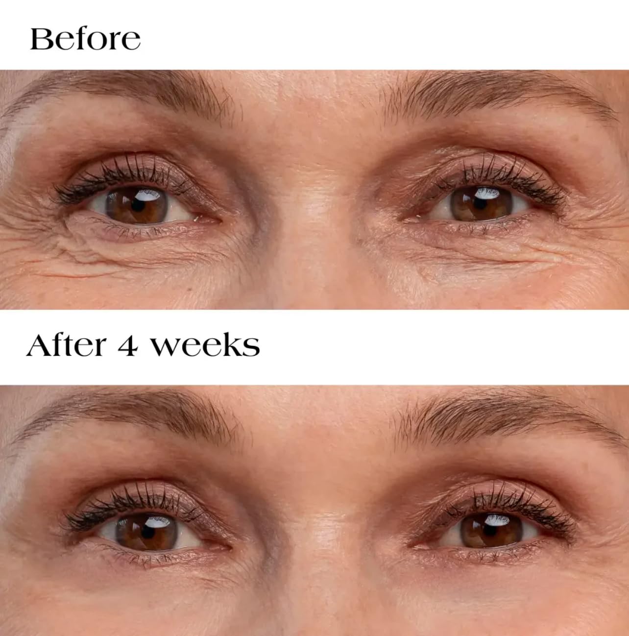 Hyaluronic Acid Collagen Micro Patches dissolving nanodarts visible, delivering actives to the eye area.