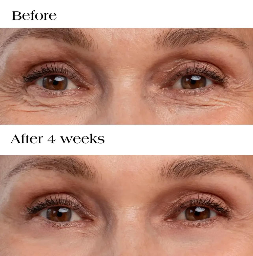Hyaluronic Acid Collagen Micro Patches dissolving nanodarts visible, delivering actives to the eye area.
