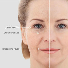 Hyaluronic Acid Collagen Micro Patches beneath the eye with even absorption.