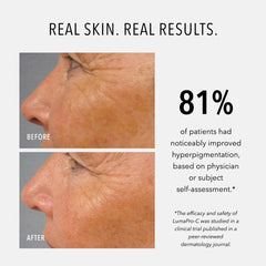 Texture swirl on skin implying even tone with LumaPro-C.