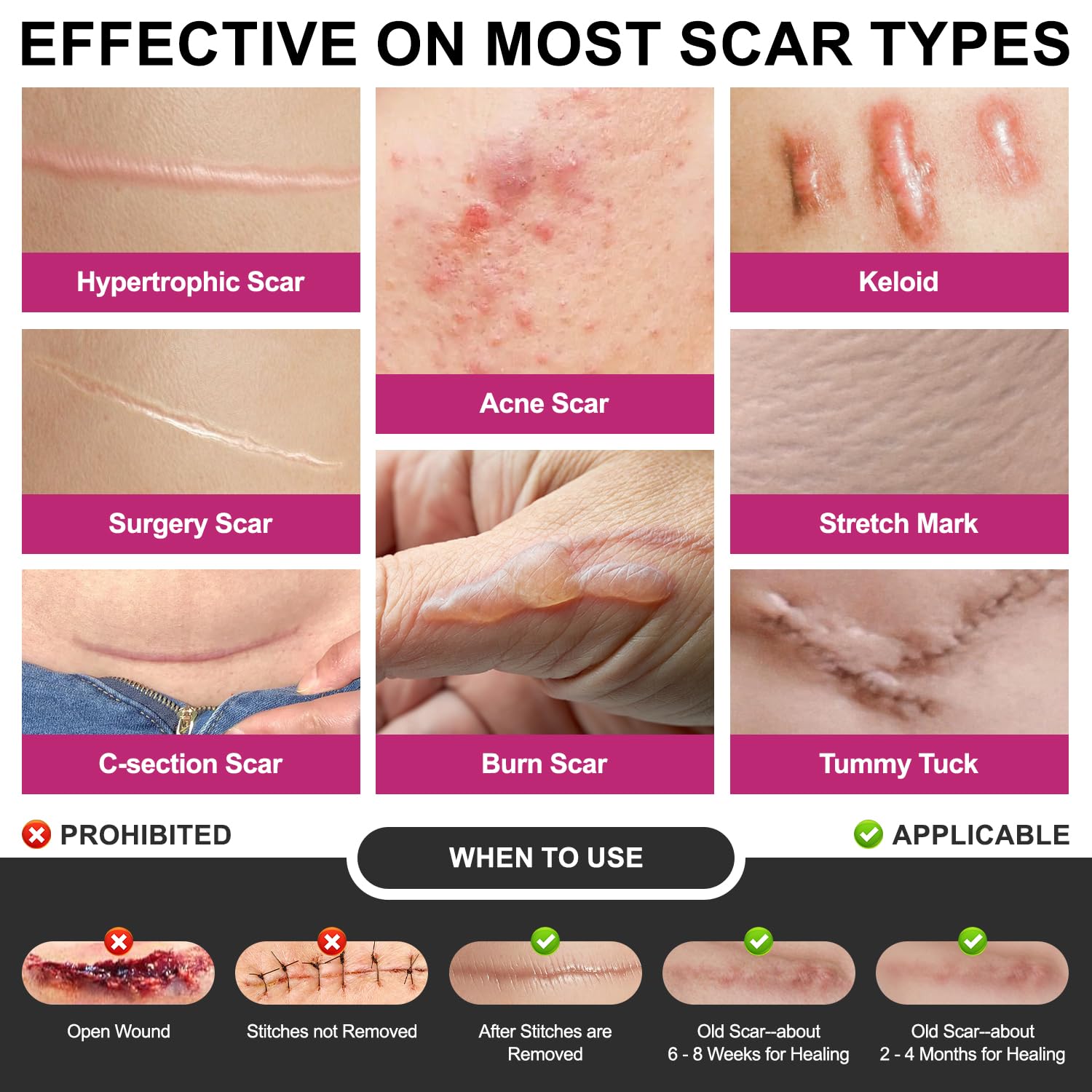 Hysimedy scar tape on a burn scar to support hydration and texture.