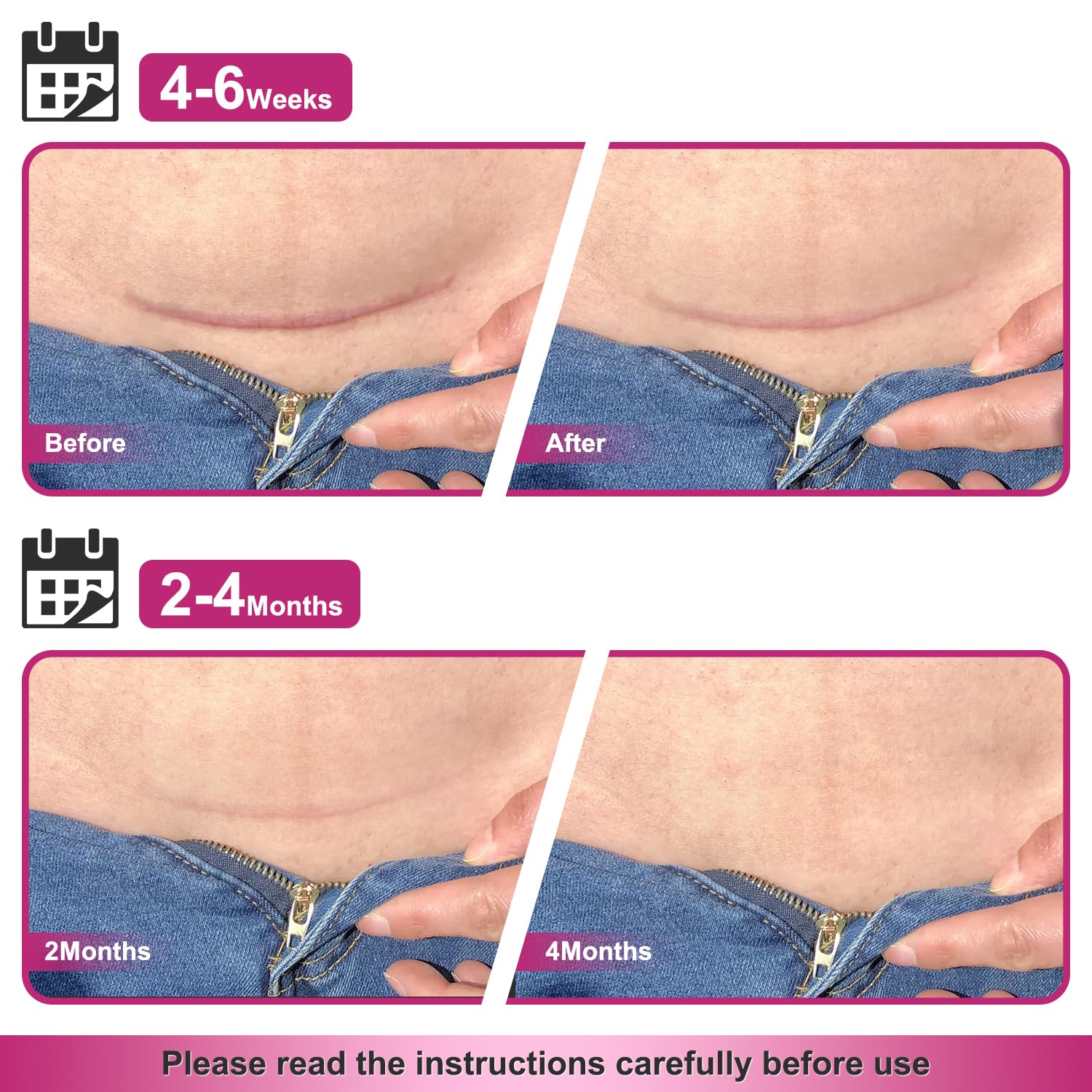 Hysimedy silicone scar tape helps hypertrophic scar appearance gradually.