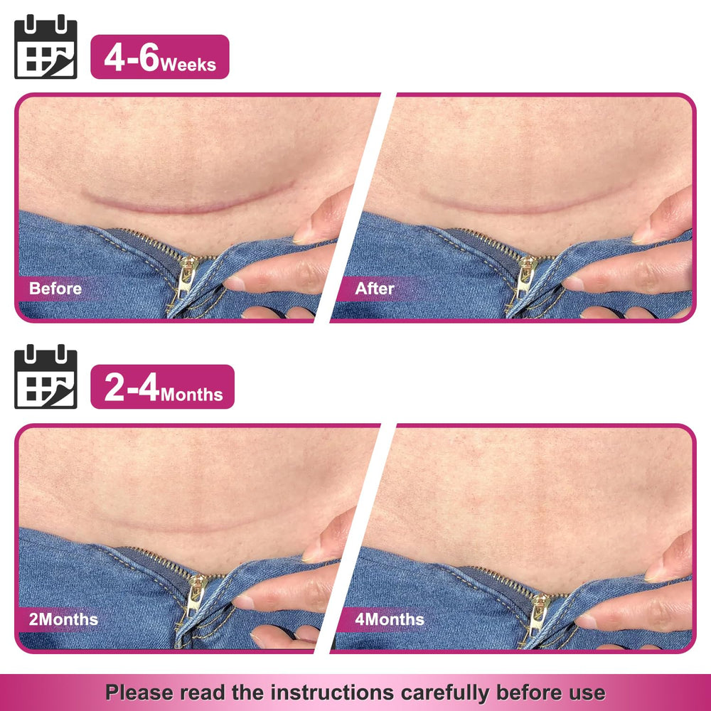 Hysimedy silicone scar tape helps hypertrophic scar appearance gradually.