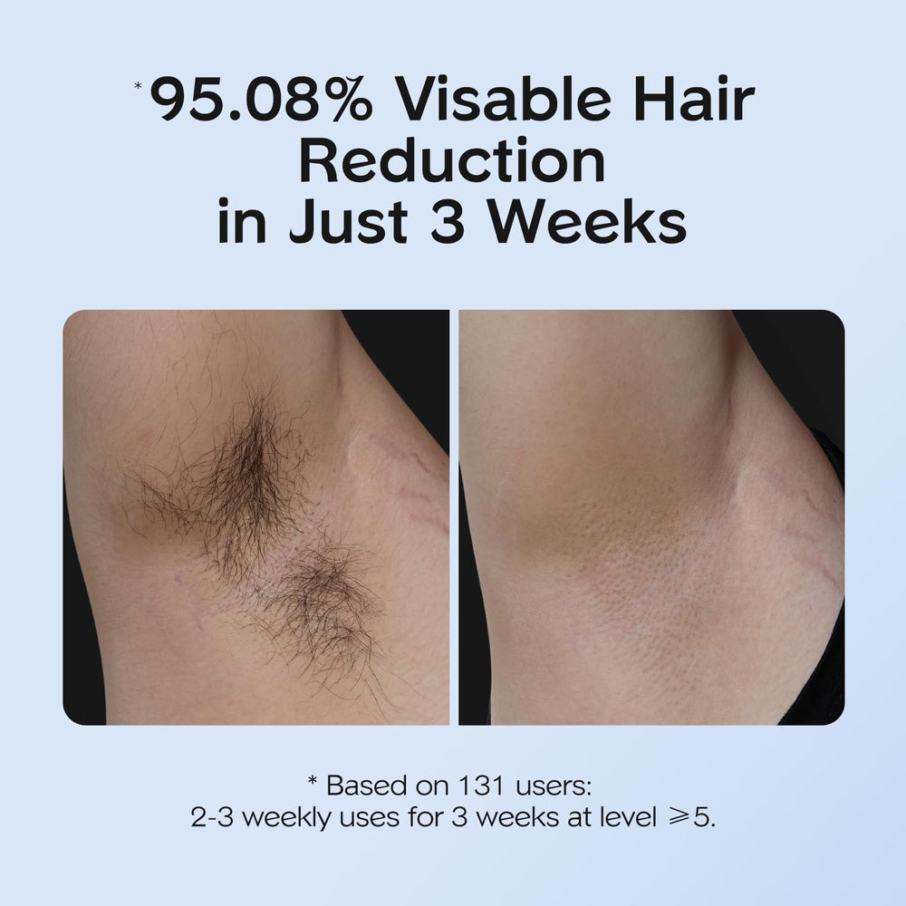 INNZA IPL manual mode used for small, precise areas like upper lip