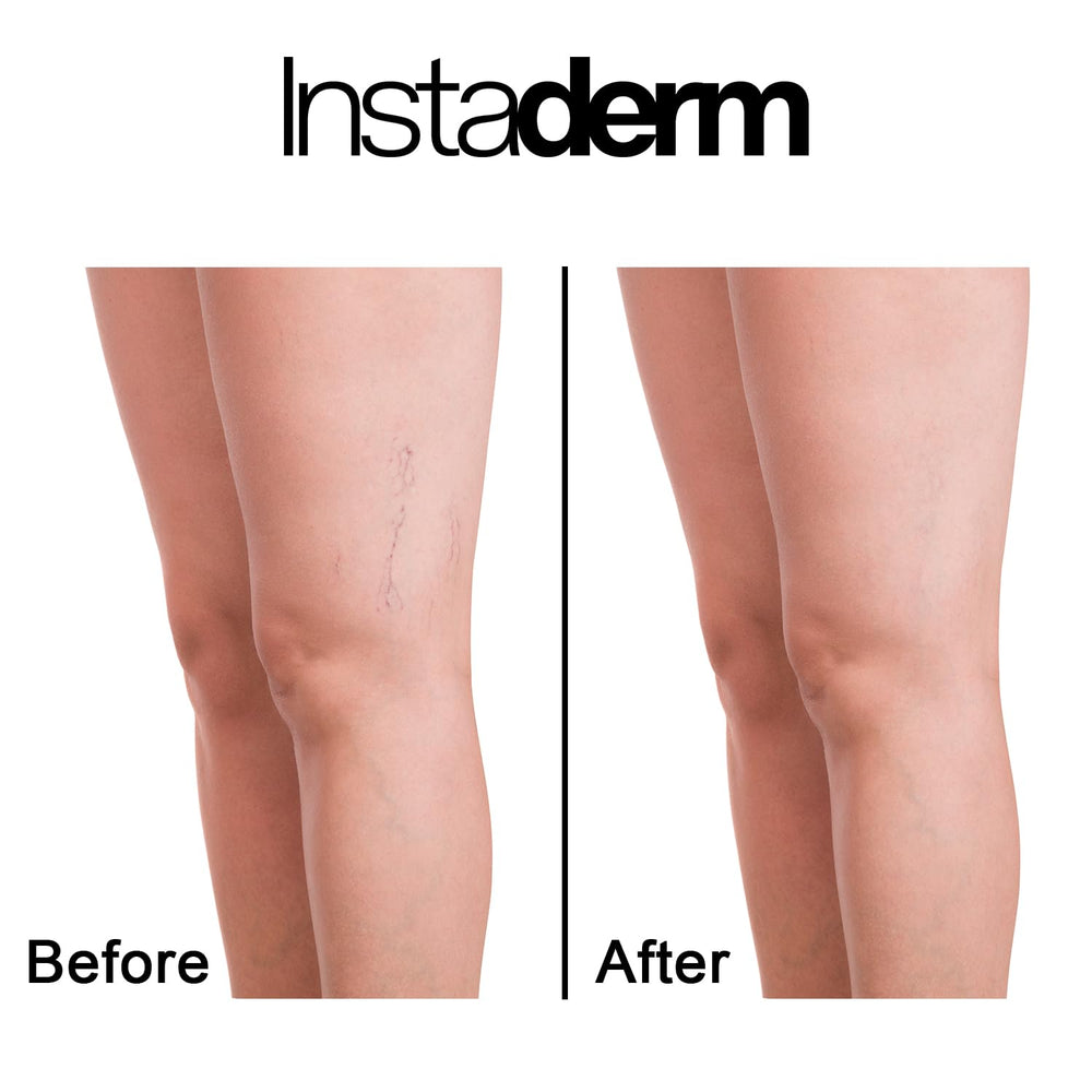 Applying Instaderm to a bruise for potential faster appearance improvement.
