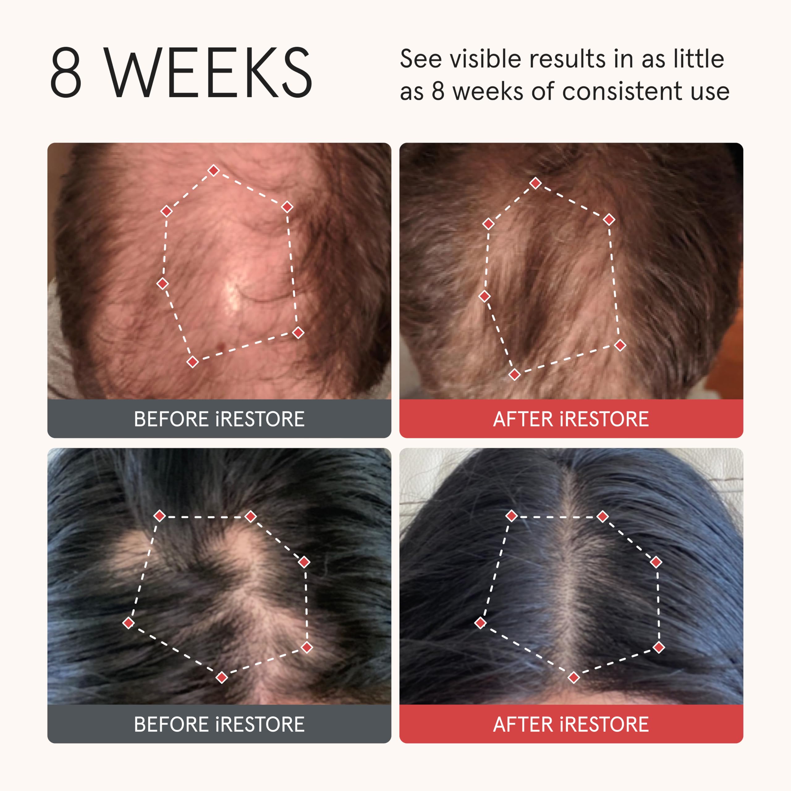 iRestore biotin complex ingredients showcase nourishing compounds for healthier hair growth potential.