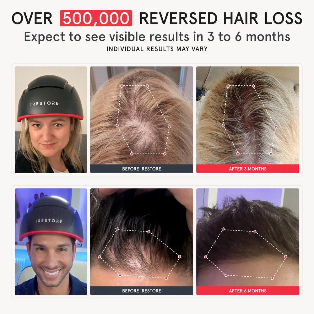 iRestore Elite shows 500 lasers and LEDs for even scalp coverage.
