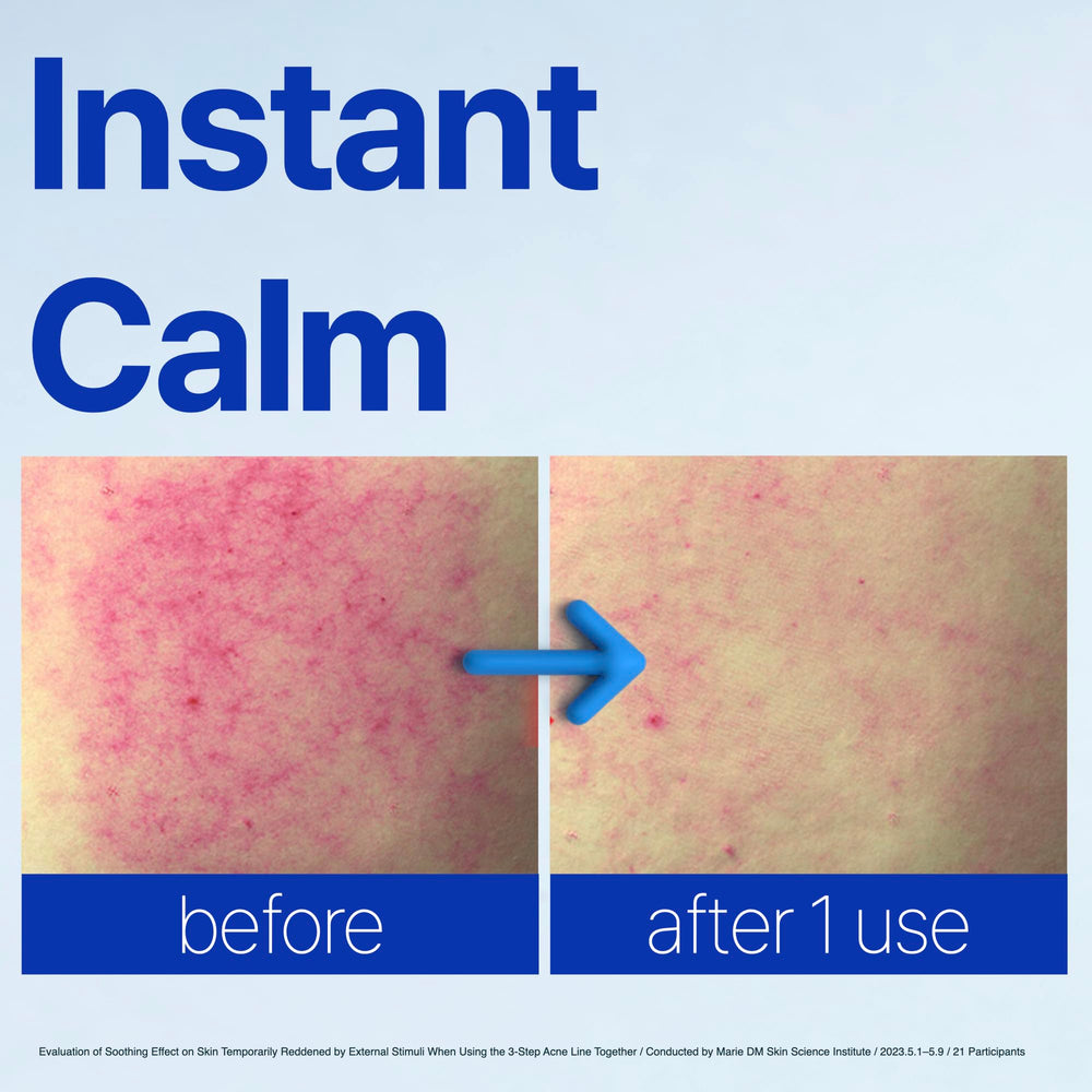 ISOI ACNI Dr. 1st Speedy Gel Cream closeup texture absorbs quickly