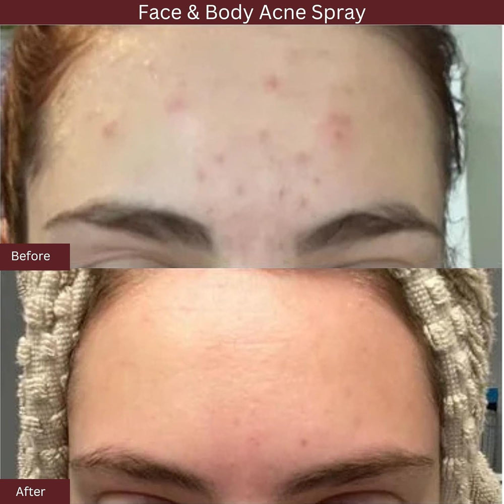 ITK Skincare bacne areas spray for clearer skin.