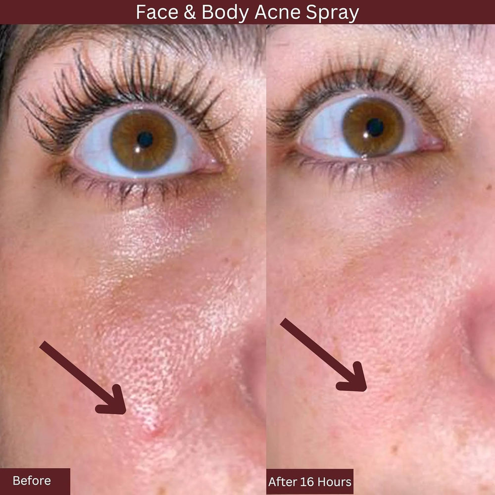 ITK Skincare spray targets blackheads for smoother skin.