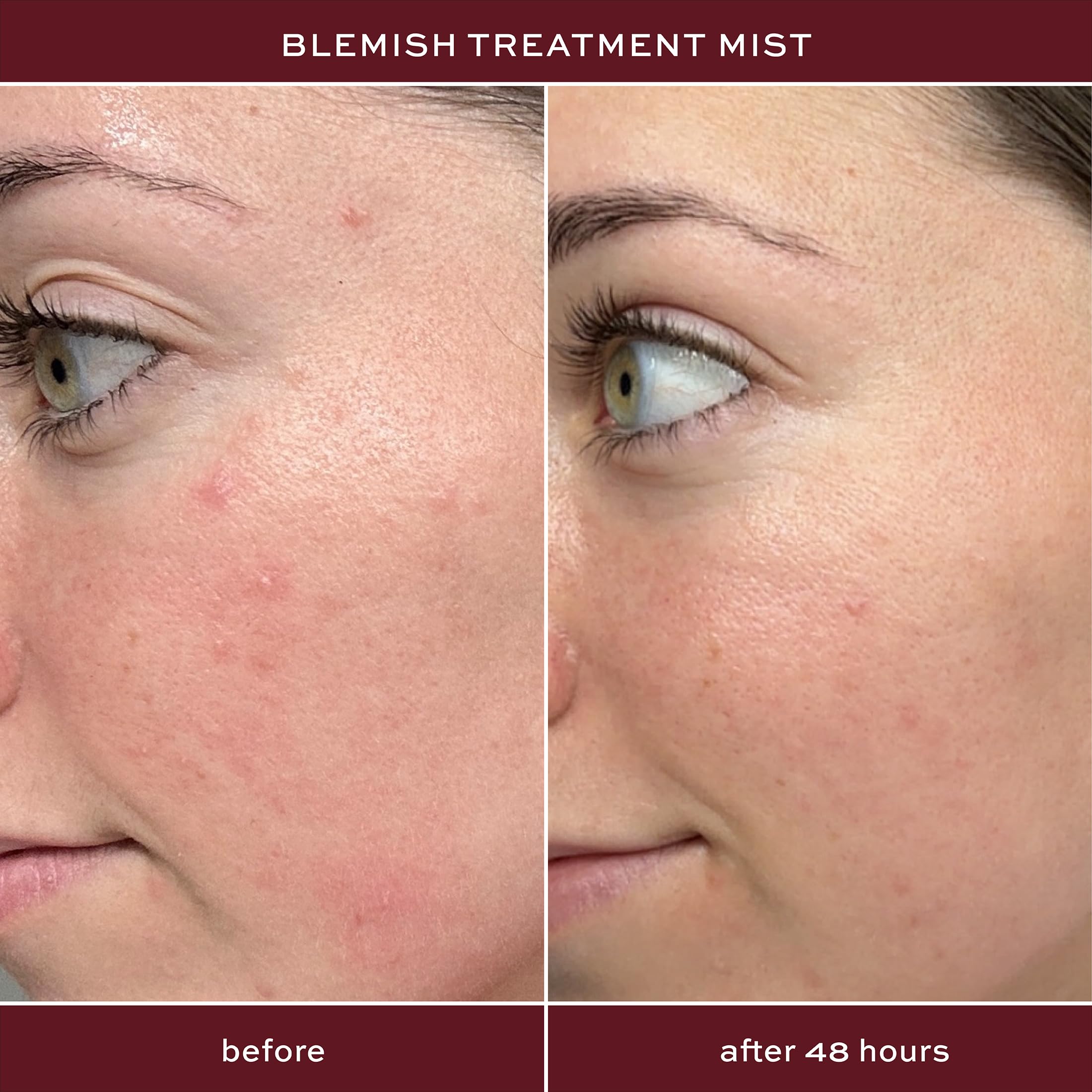 ITK Skincare 2% spray applied to the face for blemish control.