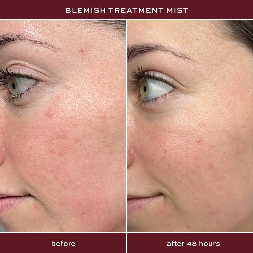 ITK Skincare 2% spray applied to the face for blemish control.