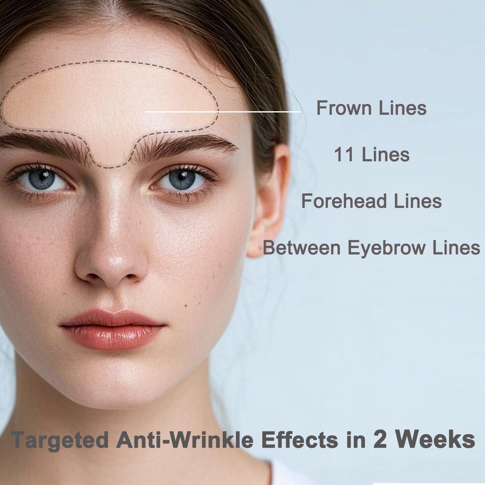 Iyxicmi patch on glabellar lines showing precise fit for frown lines