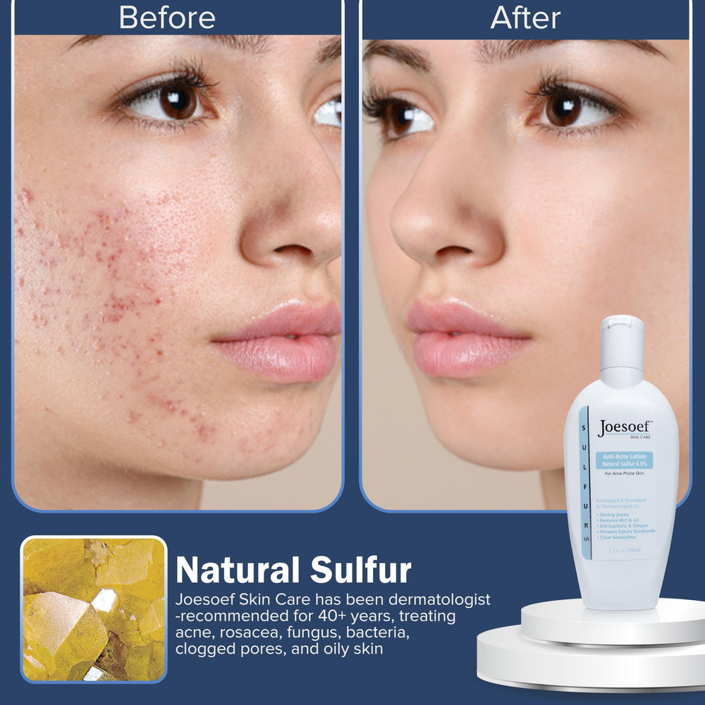 JOESOEF SKIN CARE anti-acne lotion texture and usage