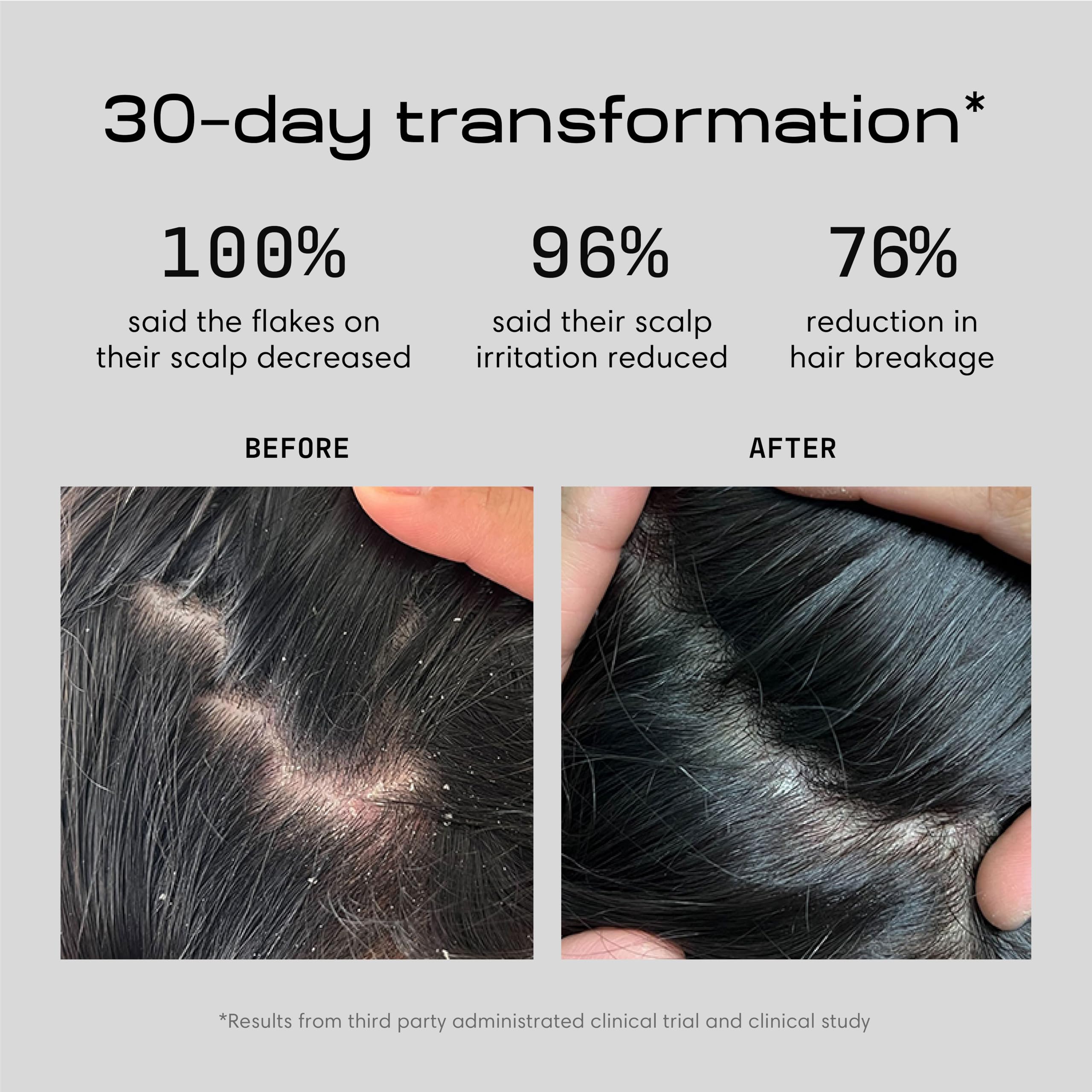 Jupiter shampoo lather shown during application for itchy, flaky scalp relief
