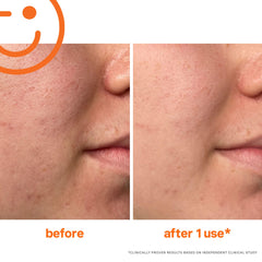 Kate Somerville Exfolikate Intensive features lactic acid and fruit enzymes