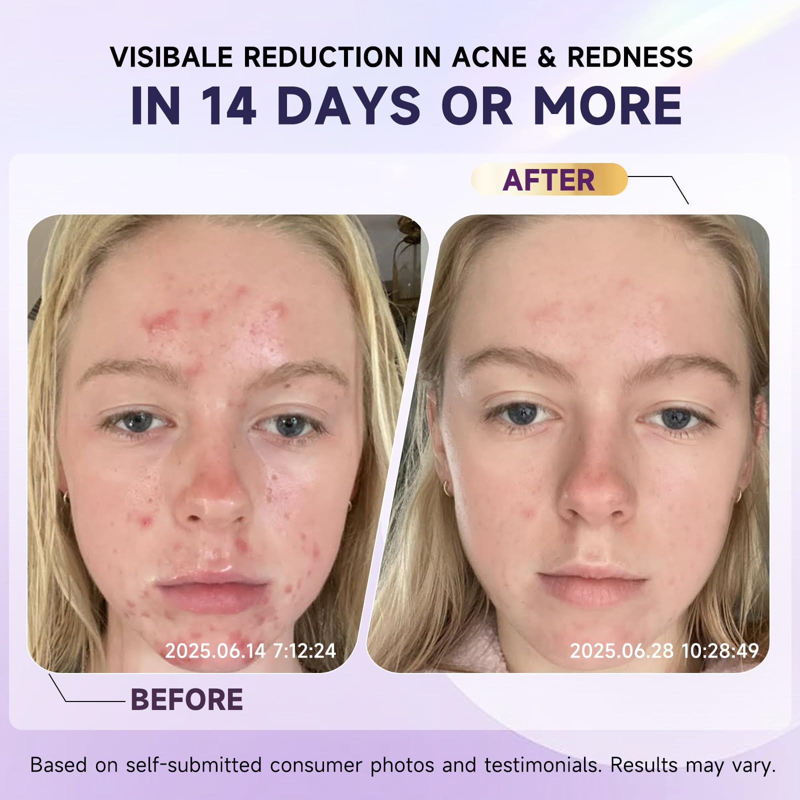 Kempc soothing face cream close-up demonstrates reduced redness for rosacea-prone skin.