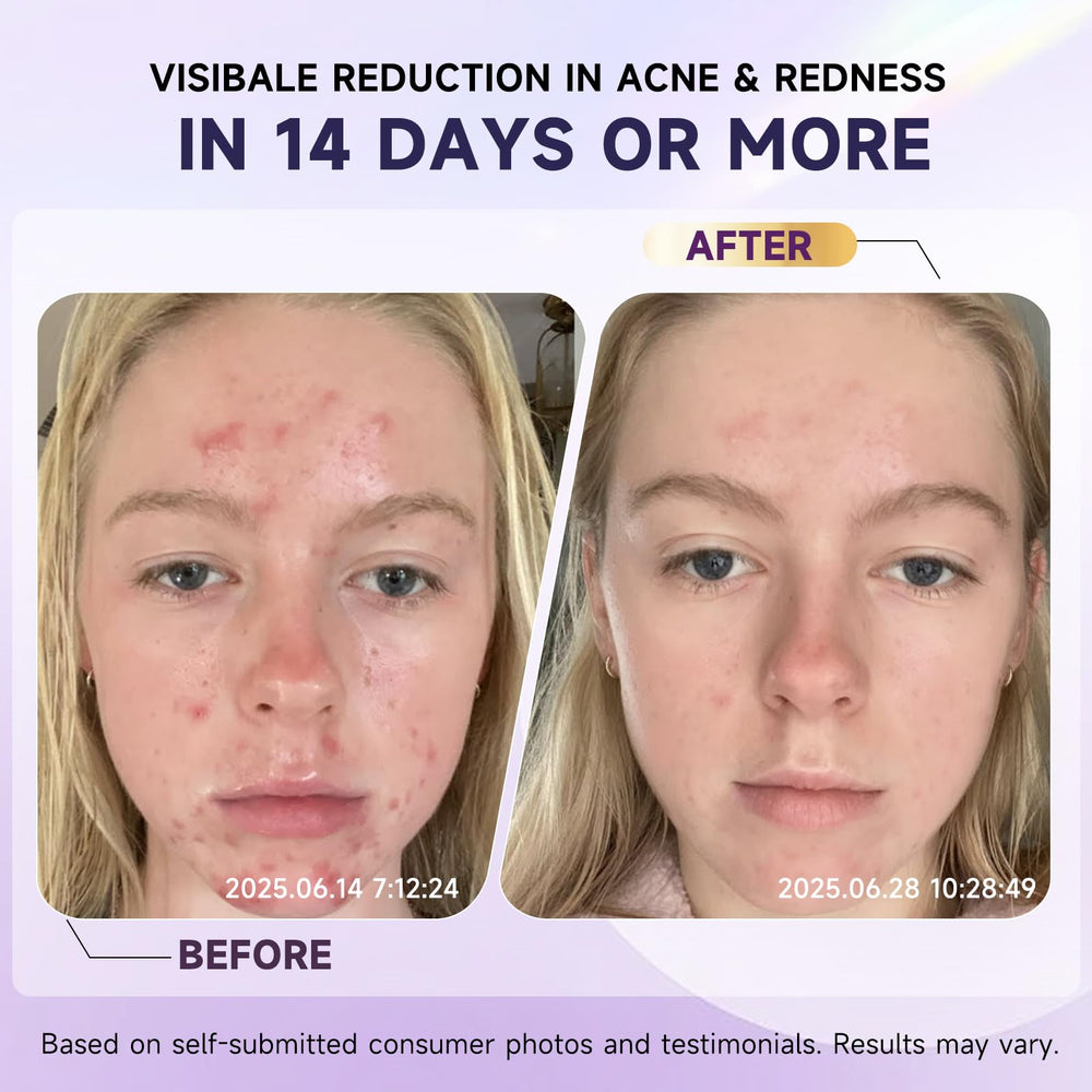 Kempc soothing face cream close-up demonstrates reduced redness for rosacea-prone skin.