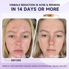 Kempc soothing face cream close-up demonstrates reduced redness for rosacea-prone skin.