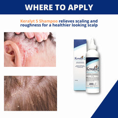 Keralyt 5 shampoo shower scene shows easy pre-shower application