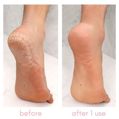 Kiara Sky Heeling Callus Remover Set foot file delivers effective exfoliation for rough skin