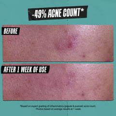 Spot-treatment application on blemish with Kiehl's cleansing paste
