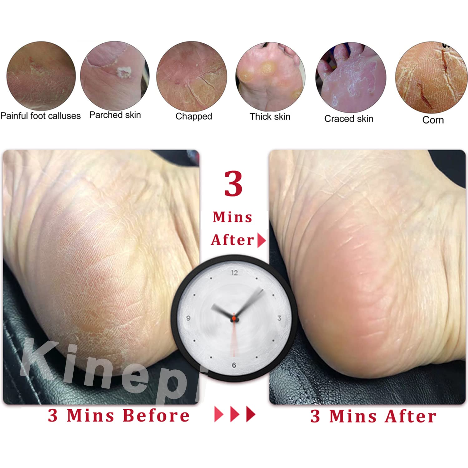 Kinepi pumice stone for feet promotes smooth heels after showers