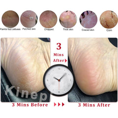 Kinepi pumice stone for feet promotes smooth heels after showers