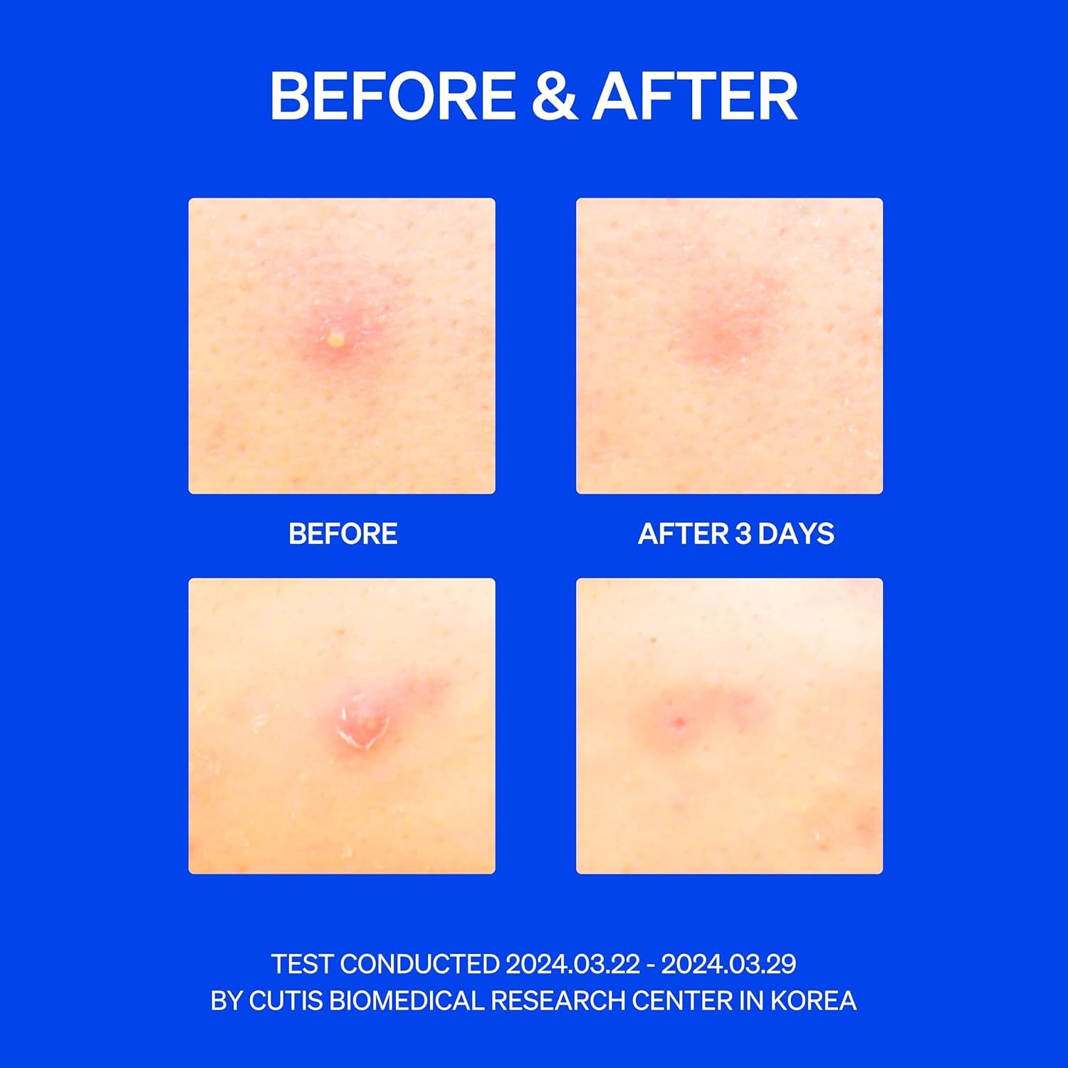 KNEMO RIGHT AWAY patch is dermalogically tested for safe use