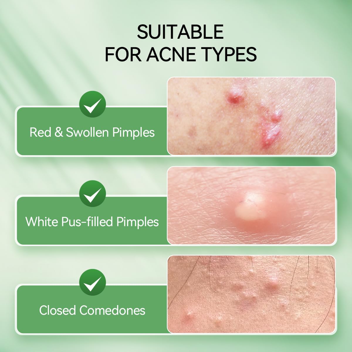 LANBENA drying lotion texture on skin suggesting gentle overnight blemish care