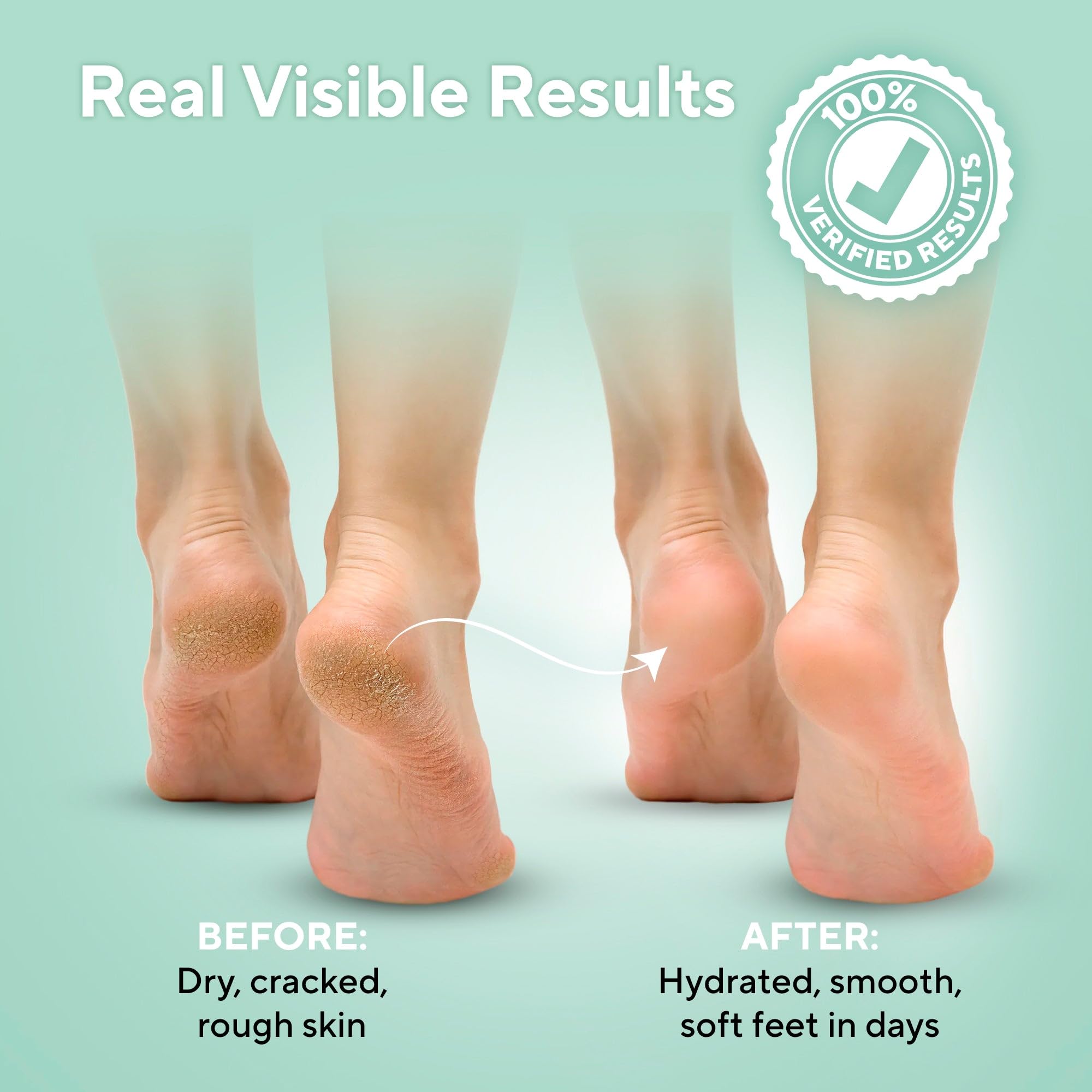 Lavinso Urea Cream softens rough skin on heels.