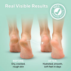 Lavinso Urea Cream softens rough skin on heels.