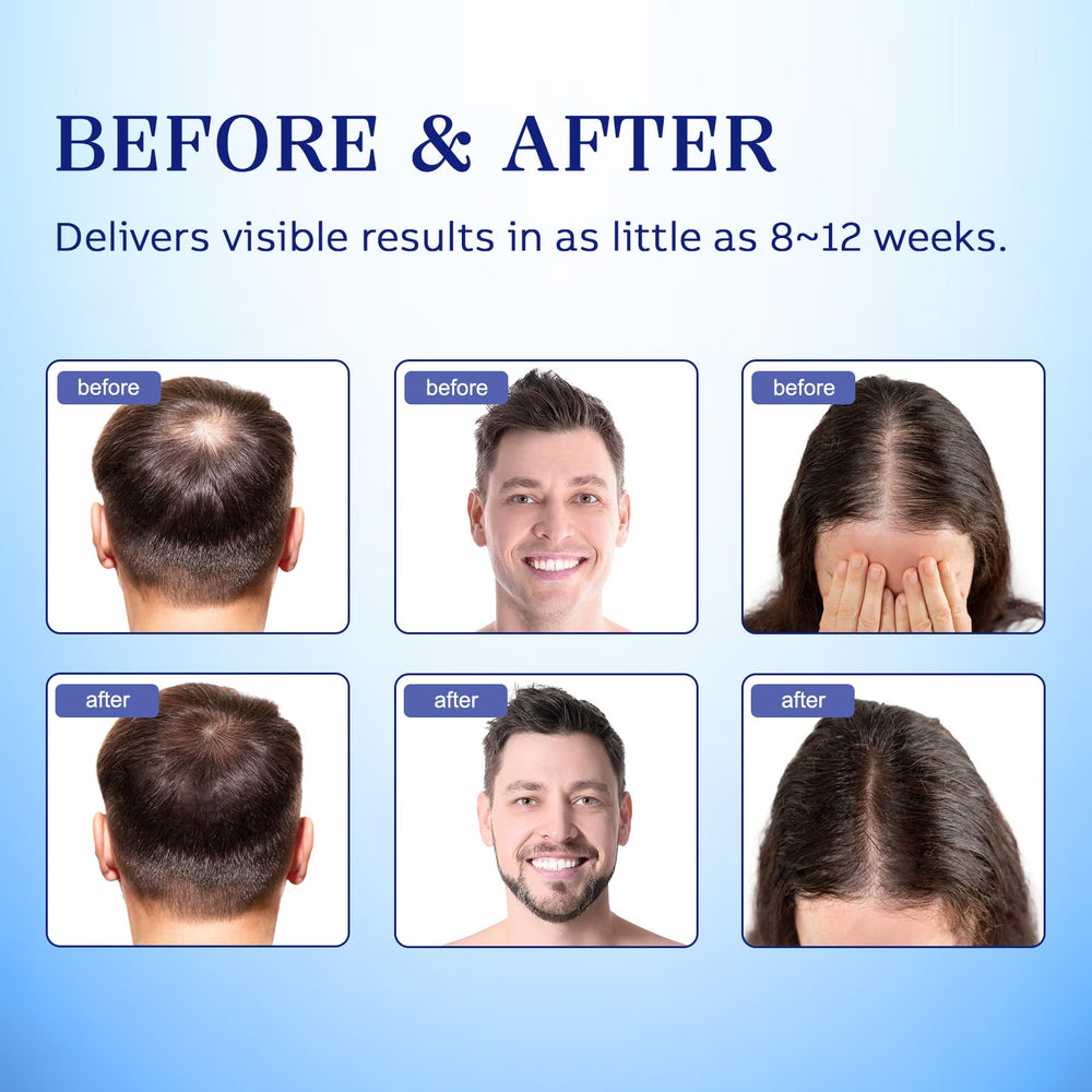 Lavtek Minoxidil scalp application being applied to thinning areas.