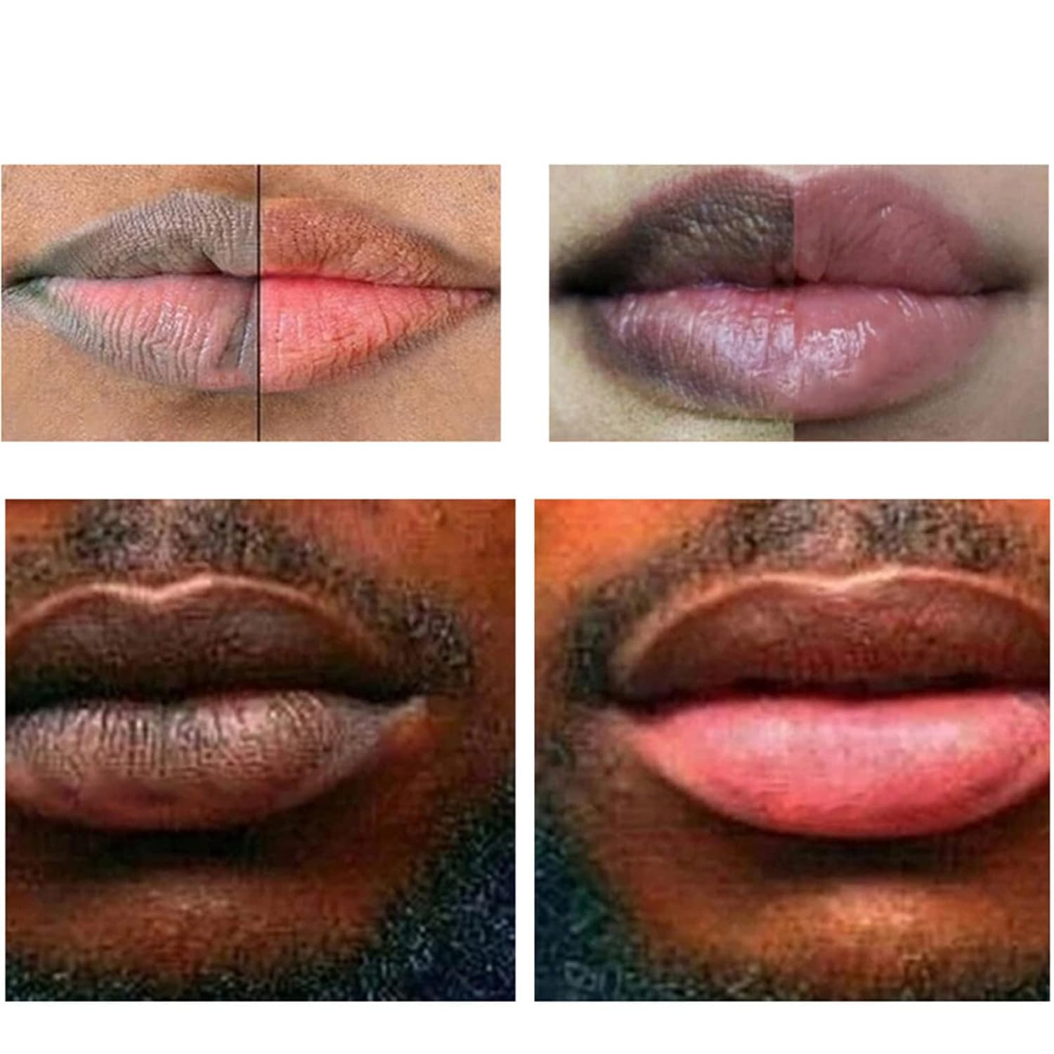 LCRORO dark pigmentation before-after focus on potential lightening.