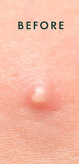 Lexie Kool Patch protects from picking and external irritation.