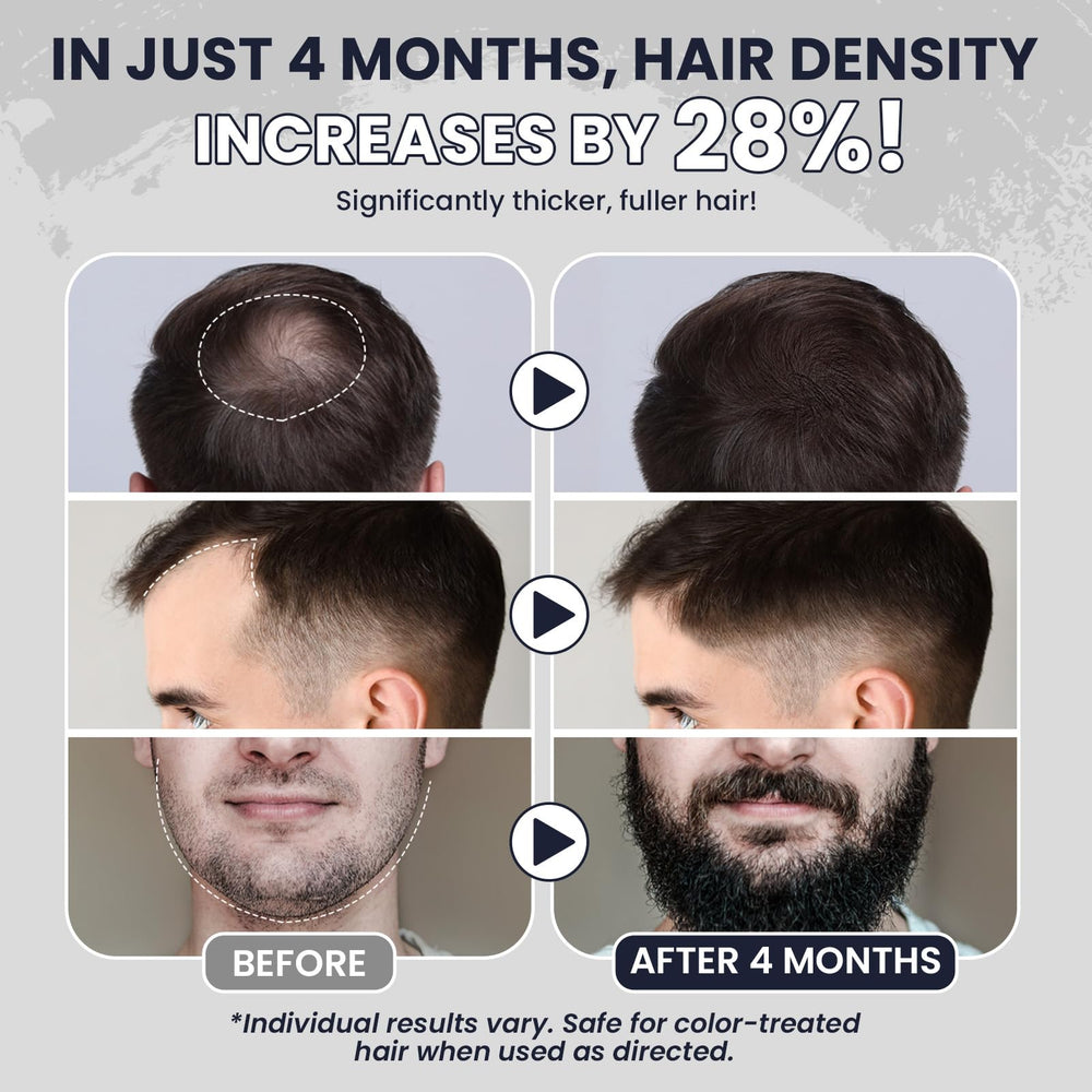 LIPEND 5% Minoxidil bottle top view shows compact packaging for easy daily use.